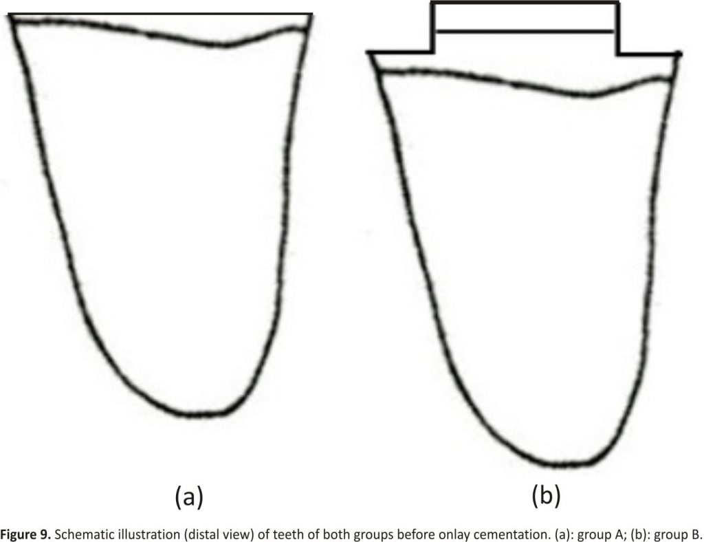 Figure 9. Schematic illustration (distal view) of teeth of both groups before onlay cementation. (a): group A; (b): group B.