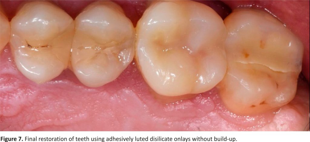 Figure 7. Final restoration of teeth using adhesively luted disilicate onlays without build-up.