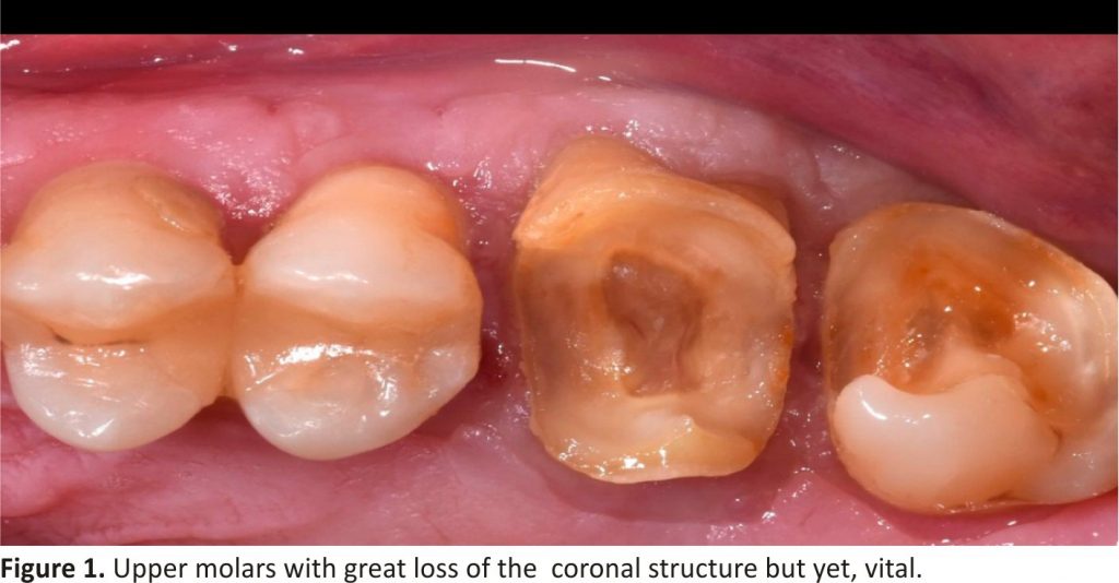 Figure 1. Upper molars with great loss of the coronal structure but yet, vital.