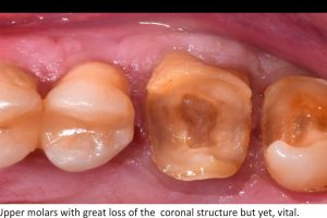 Figure 1. Upper molars with great loss of the coronal structure but yet, vital.