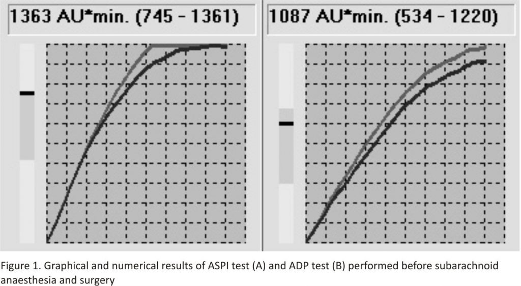 Figure 1. Graphical and numerical results of ASPI test (A) and ADP test (B) performed before subarachnoid anaesthesia and surgery