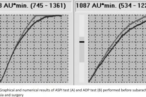 Figure 1. Graphical and numerical results of ASPI test (A) and ADP test (B) performed before subarachnoid anaesthesia and surgery