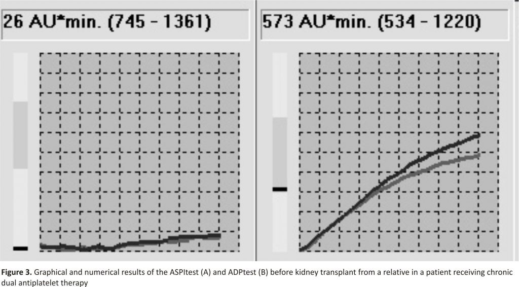 Figure 3. Graphical and numerical results of the ASPItest (A) and ADPtest (B) before kidney transplant from a relative in a patient receiving chronic dual antiplatelet therapy