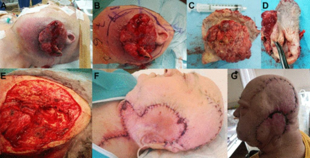 The Use of Giant Bilobed Flaps for Tissue Defect Reconstruction After Temporal Bone and Ear Resection