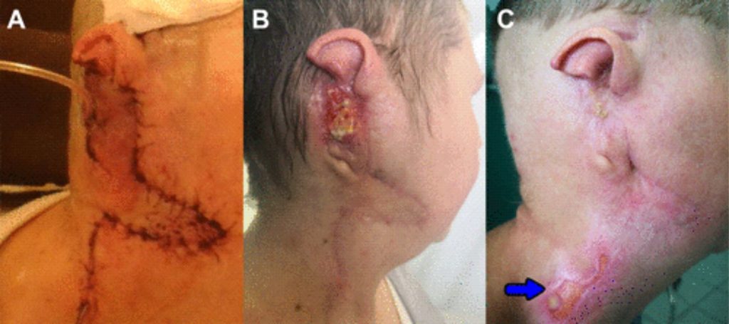 The Use of Giant Bilobed Flaps for Tissue Defect Reconstruction After Temporal Bone and Ear Resection 