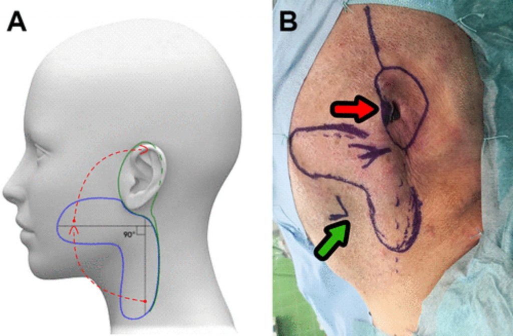 The Use of Giant Bilobed Flaps for Tissue Defect Reconstruction After Temporal Bone and Ear Resection 