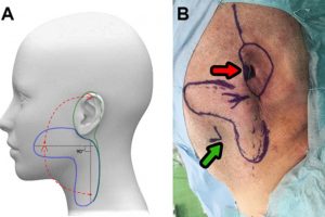 The Use of Giant Bilobed Flaps for Tissue Defect Reconstruction After Temporal Bone and Ear Resection