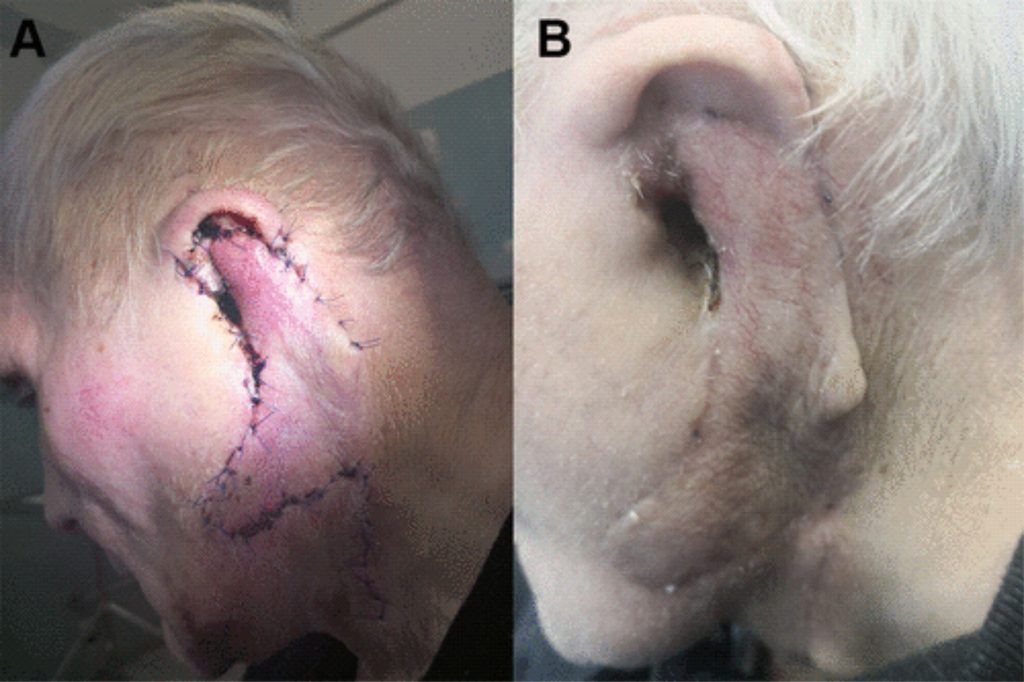 The Use of Giant Bilobed Flaps for Tissue Defect Reconstruction After Temporal Bone and Ear Resection