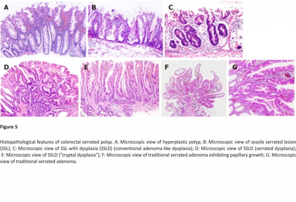 Histopathological features of colorectal serrated polyp. A: Microscopic view of hyperplastic polyp; B: Microscopic view of sessile serrated lesion (SSL); C: Microscopic view of SSL with dysplasia (SSLD) (conventional adenoma-like dysplasia); D: Microscopic view of SSLD (serrated dysplasia); E: Microscopic view of SSLD (“cryptal dysplasia”); F: Microscopic view of traditional serrated adenoma exhibiting papillary growth; G: Microscopic view of traditional serrated adenoma.