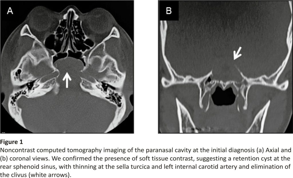 Noncontrast computed tomography imaging of the paranasal cavity 