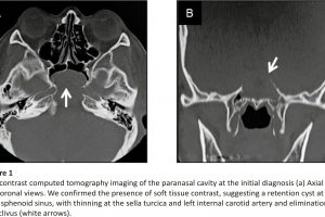 Noncontrast computed tomography imaging of the paranasal cavity