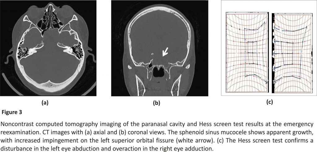 Noncontrast computed tomography imaging of the paranasal cavity and Hess screen test
