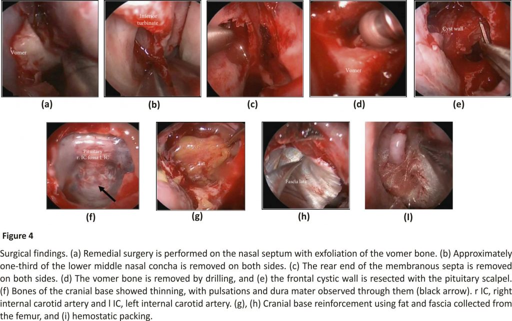 Surgical findings. (a) Remedial surgery is performed on the nasal septum with exfoliation of the vomer bone.