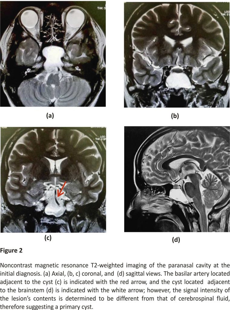 Noncontrast magnetic resonance T2-weighted imaging of the paranasal cavity