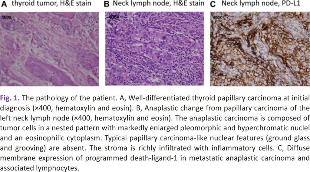 The pathology of the patient with Anaplastic Thyroid Cancer