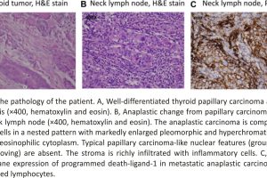 The pathology of the patient with Anaplastic Thyroid Cancer