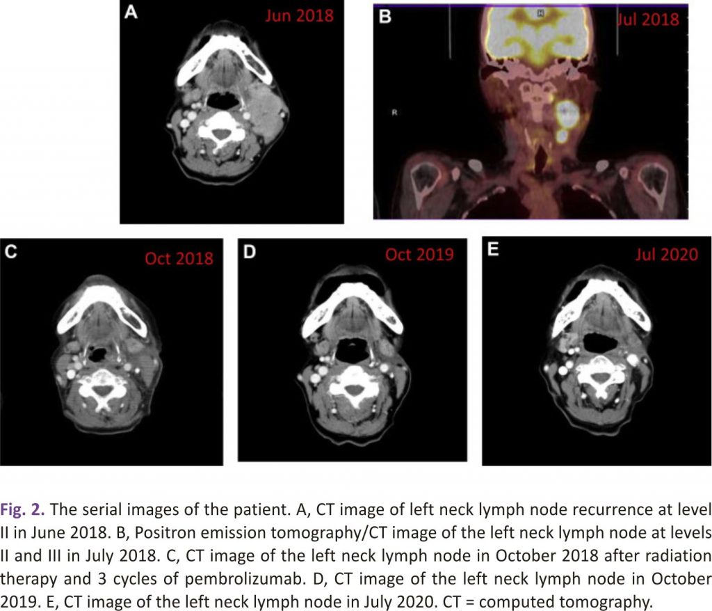 Fig. 2. The serial images of the patient in Anaplastic Thyroid Cancer.