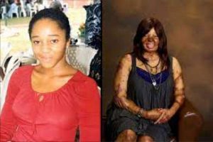 Kechi Okwuchi, a survivor of the 2005 ill-fated Sosoliso plane crash. Her new look after series of surgey.