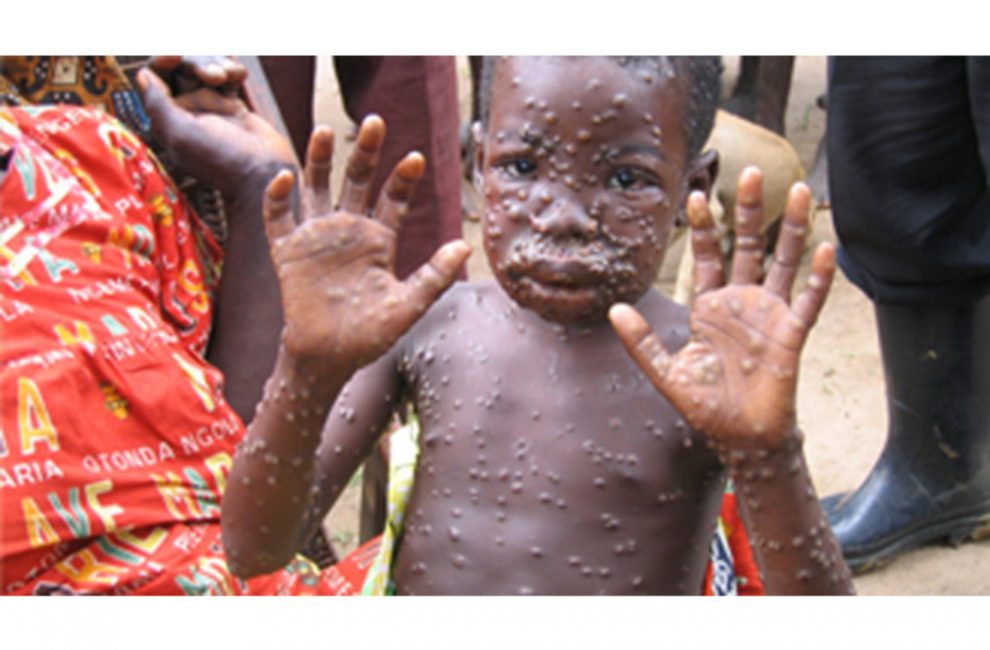 Nigerian Child found with human monkeypox in Texas