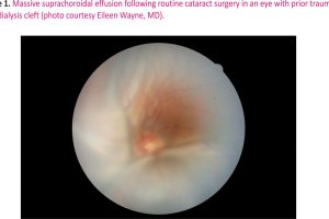 Figure 1. Massive suprachoroidal effusion following routine cataract surgery in an eye with prior trauma and cyclodialysis cleft (photo courtesy Eileen Wayne, MD)