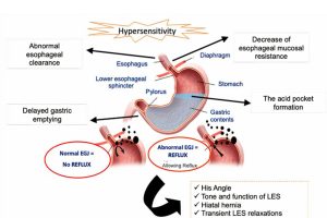 Figure 1. The complex pathogenesis of GERD.