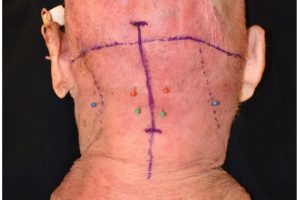 Marked 8-cm midline incision in the caudal occipital region down into the superior neck.