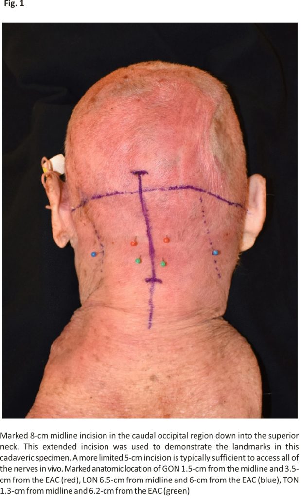 Marked 8-cm midline incision in the caudal occipital region down into the superior neck.