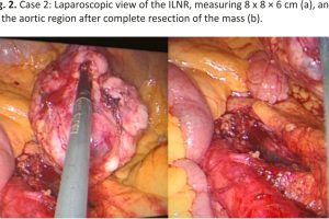 Fig. 2. Case 2: Laparoscopic view of the ILNR, measuring 8 x 8 × 6 cm (a), and of the aortic region after complete resection of the mass (b).