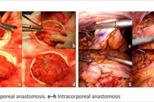 a–d Extracorporeal anastomosis. e–h Intracorporeal anastomosis