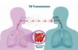 Funding cuts to tuberculosis programs endanger millions of lives