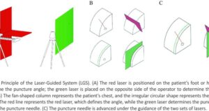 Novel Laser System-Assisted CT-Guided Percutaneous Transthoracic Lung Biopsy in Patients with COPD Combined with Pulmonary Nodules